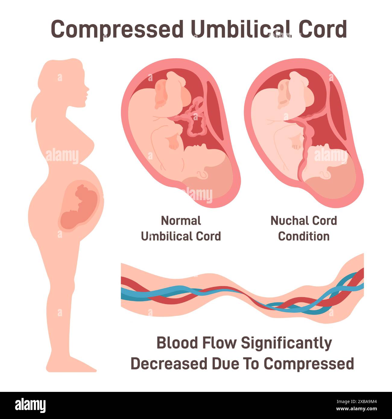 Cordon ombilical comprimé. L'obstruction du flux sanguin à travers le cordon ombilical a causé un mauvais alignement du cordon. Asphyxie foetale et risque d'évolution mortelle. Illustration vectorielle plate Illustration de Vecteur