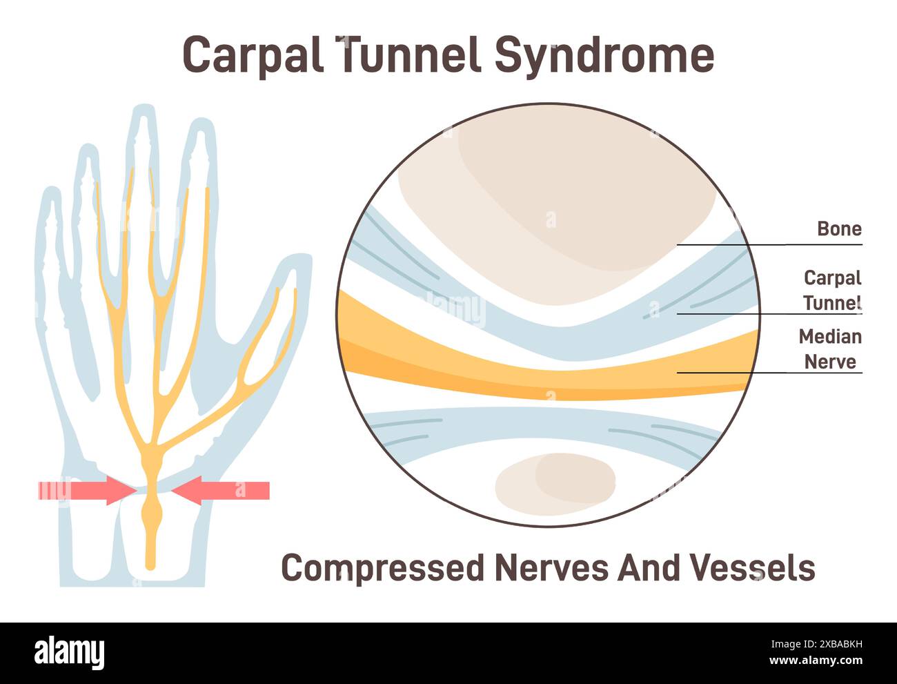 Syndrome du canal carpien. Nerf médian comprimé. Anatomie du canal carpien. Sensations des doigts, du pouce et de la paume. Illustration vectorielle plate Illustration de Vecteur