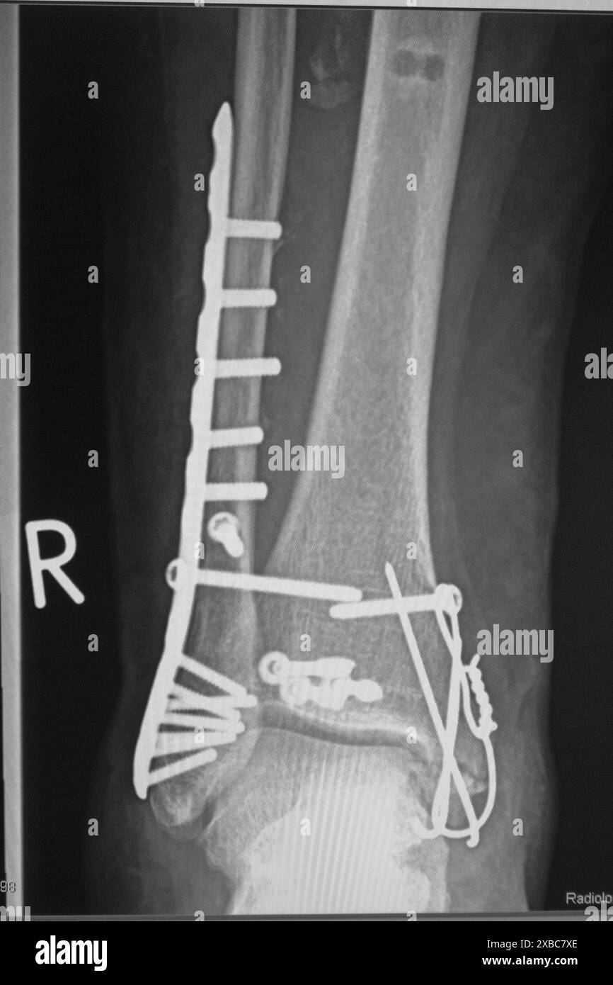 Une radiographie montre une fracture de la cheville après la chirurgie Banque D'Images