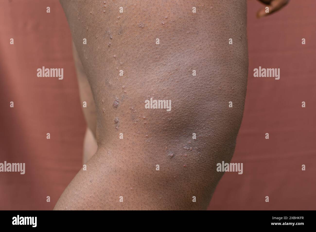 Eczéma sur peau brune, dermatite atopique et prurigo nodularis sur peau brune jambe, eczéma sur peau foncée Banque D'Images