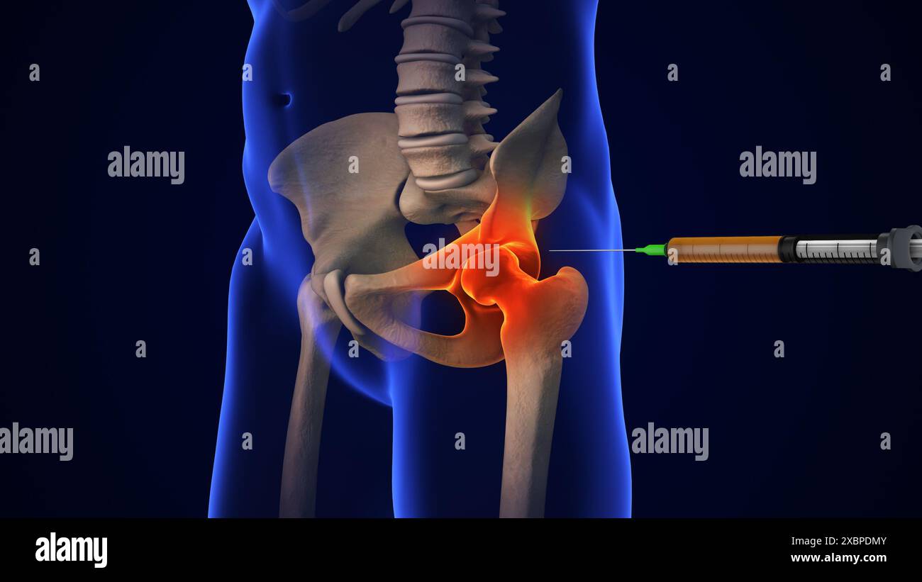 Anatomie traitement de l'articulation de la hanche humaine Banque D'Images