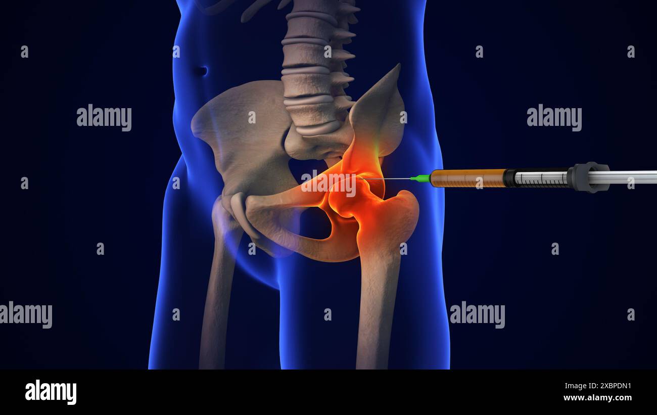 Anatomie traitement de l'articulation de la hanche humaine Banque D'Images