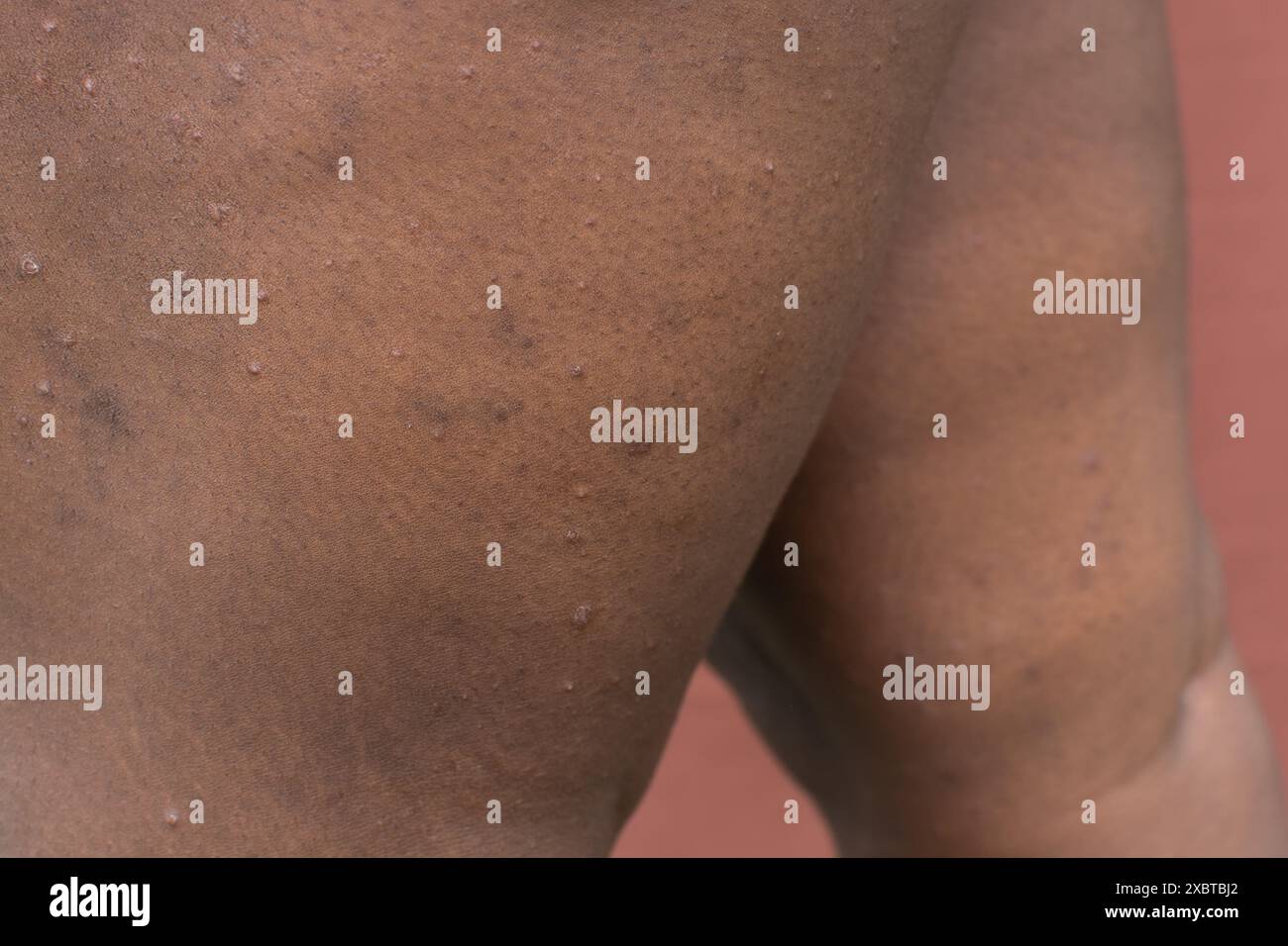 Eczéma sur peau brune, dermatite atopique et prurigo nodularis sur peau brune jambe, eczéma sur peau foncée Banque D'Images