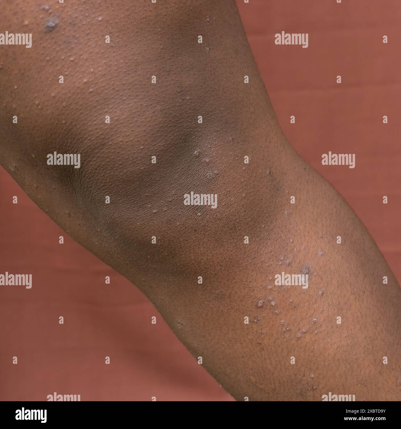 Eczéma sur peau brune, dermatite atopique et prurigo nodularis sur peau brune jambe, eczéma sur peau foncée Banque D'Images