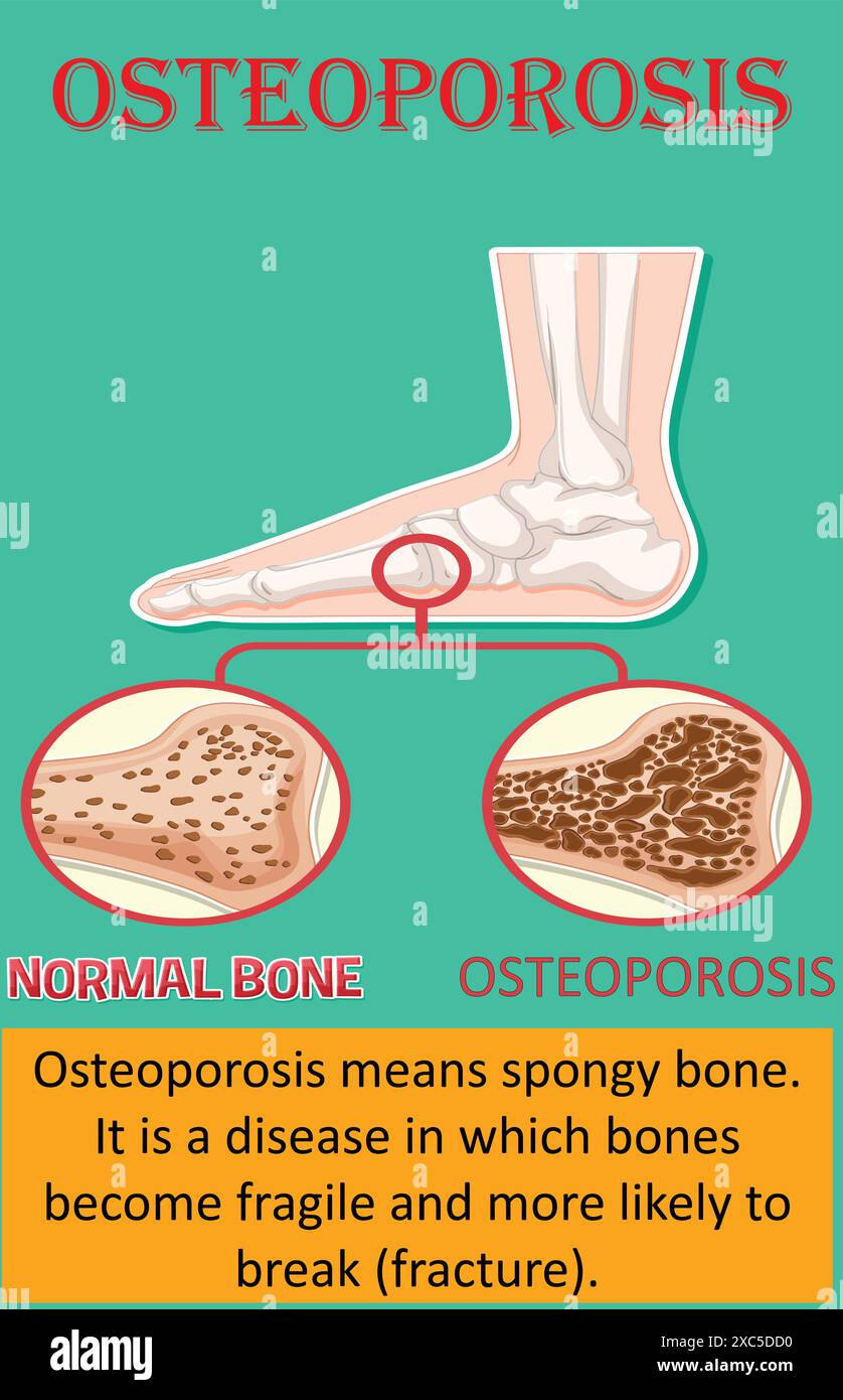 sain et avec ostéoporose. Cartoon Color ostéoporose os ad Poster Card Skeletal Health concept Flat Design. Illustration de Vecteur