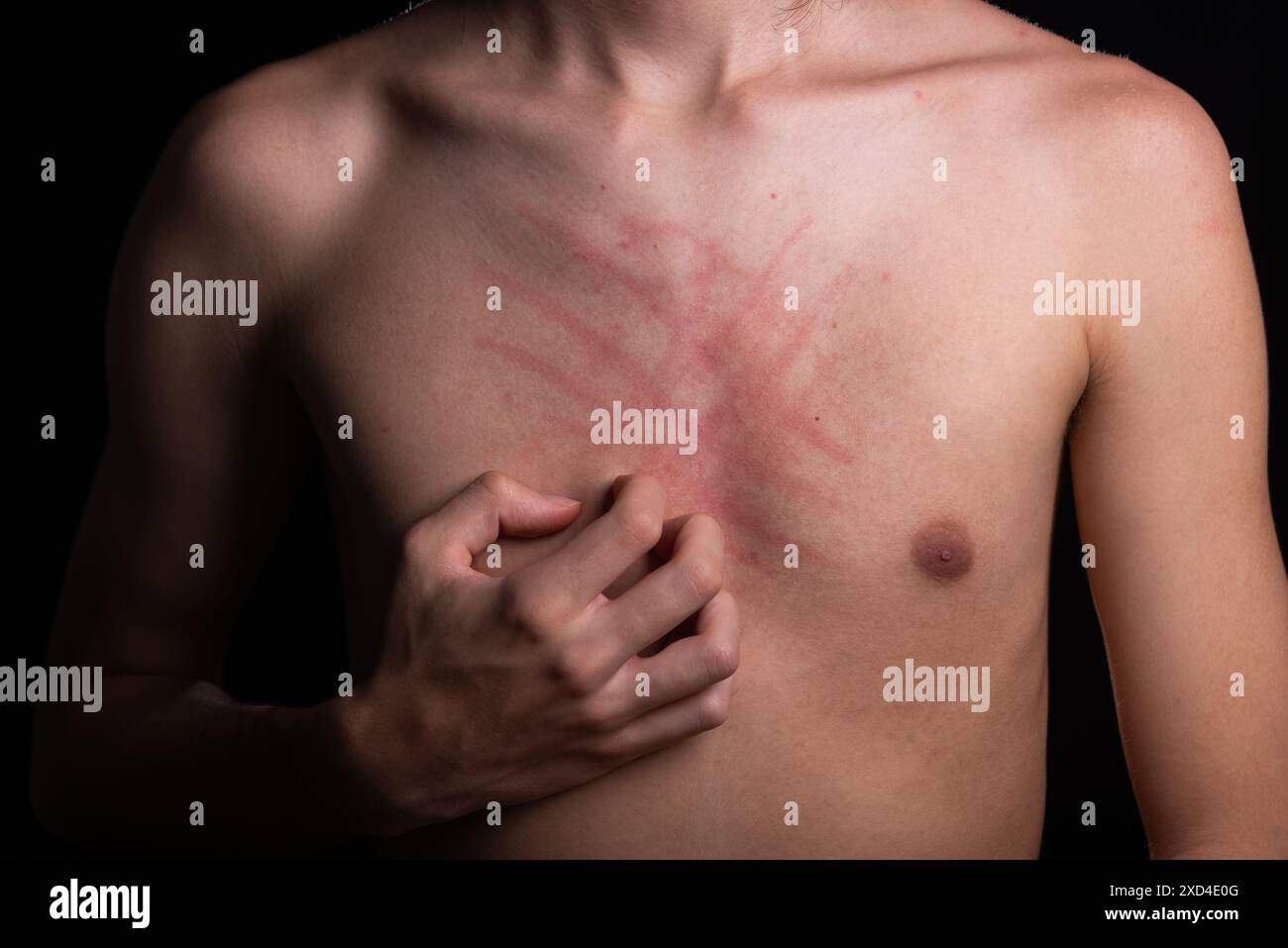 Poitrine d'un homme en colère. Démangeaisons des mains. Maladie de la peau. Irritation, allergie. Isolé sur fond noir. Banque D'Images