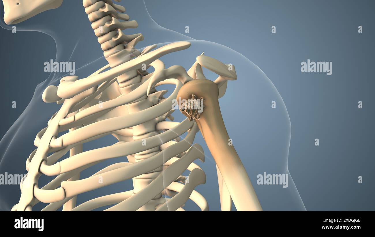 Cancer se propageant le long d'un os de l'épaule Banque D'Images