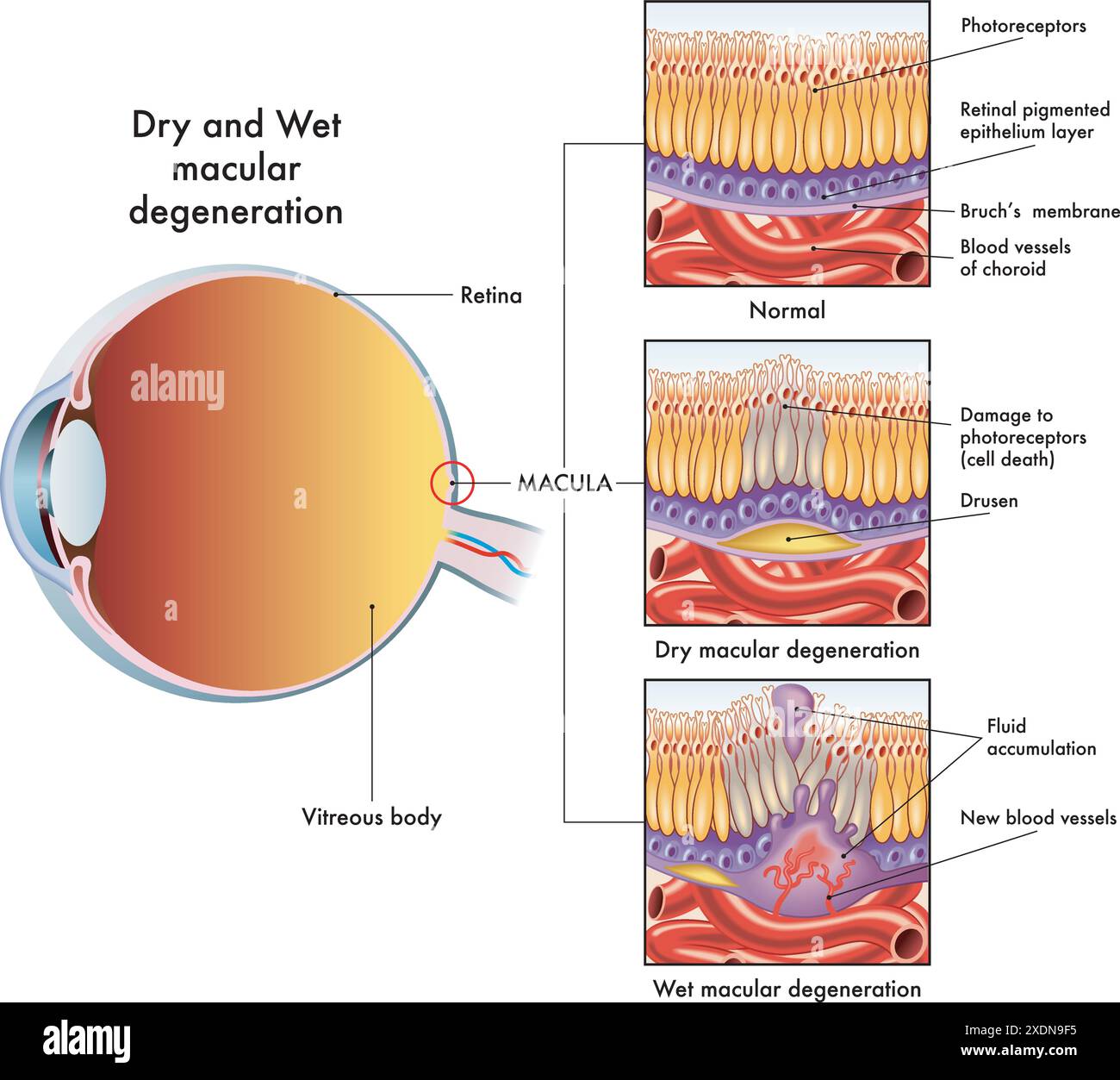 L’illustration médicale montre les symptômes affectant un œil affecté par une maculopathie sèche et humide, avec des annotations. Illustration de Vecteur