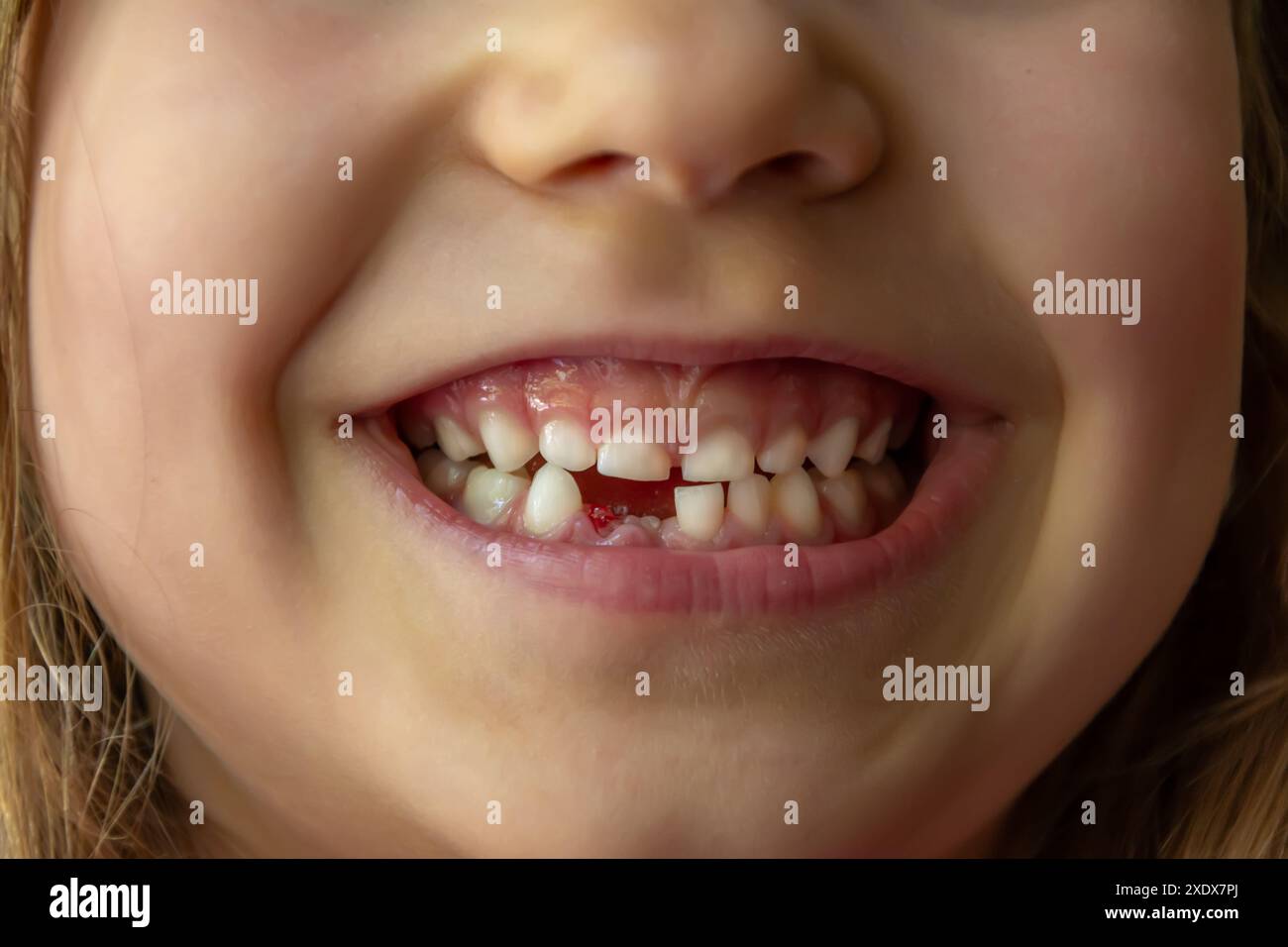 Gros plan de la bouche d'une fille souriante avec une dent de devant manquante. Un enfant manque une dent et plusieurs autres dents sont lâches, stades typiques de perte Banque D'Images