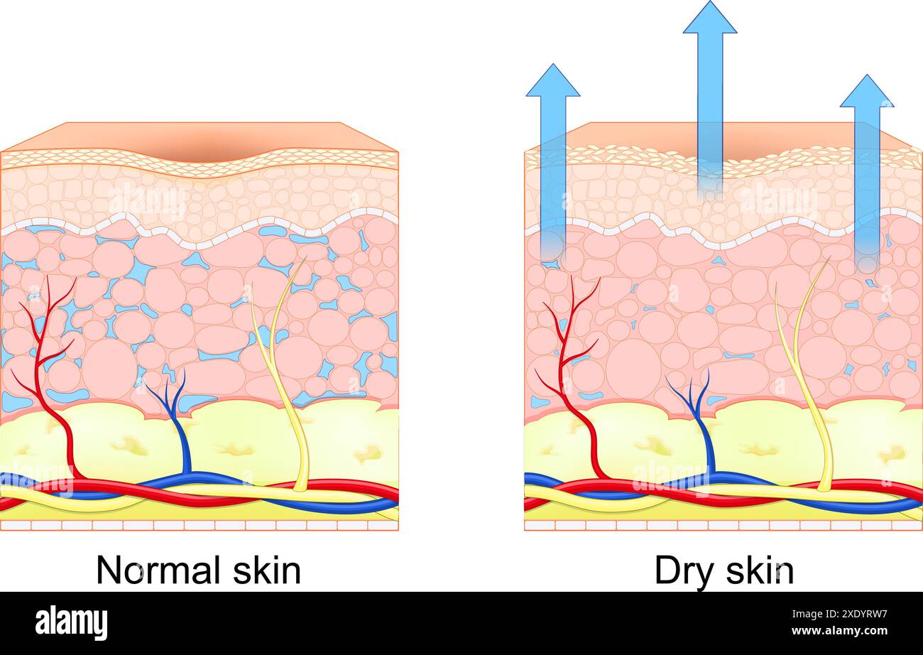 Peau sèche et normale. Section transversale de la peau humaine. Perte d'humidité dans la peau humaine. Illustration vectorielle Illustration de Vecteur