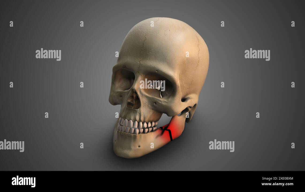 Un crâne avec mâchoire cassée Banque D'Images