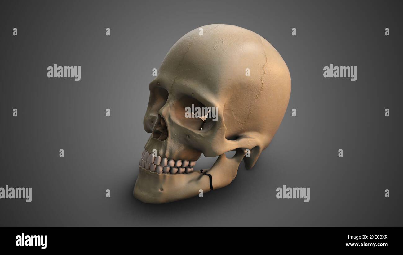 Un crâne avec mâchoire cassée Banque D'Images