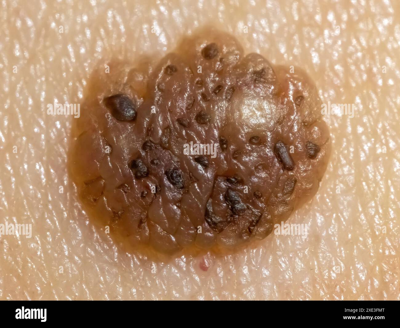 Macro-vue détaillée d'une taupe avec indications potentielles de mélanome malin. Concept : cancer de la peau Banque D'Images