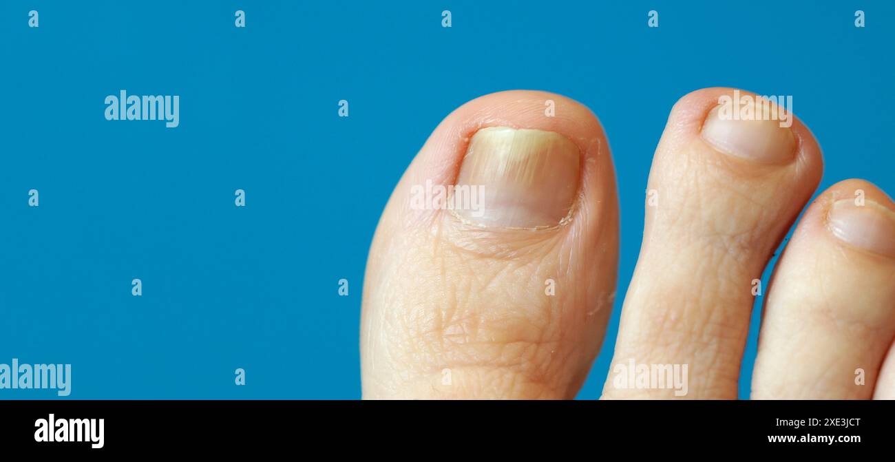 Images panoramiques de l'orteil avec le psoriasis des ongles. Une femme a un ongle en forme de crapaule. Ongles coupés courts. Banque D'Images