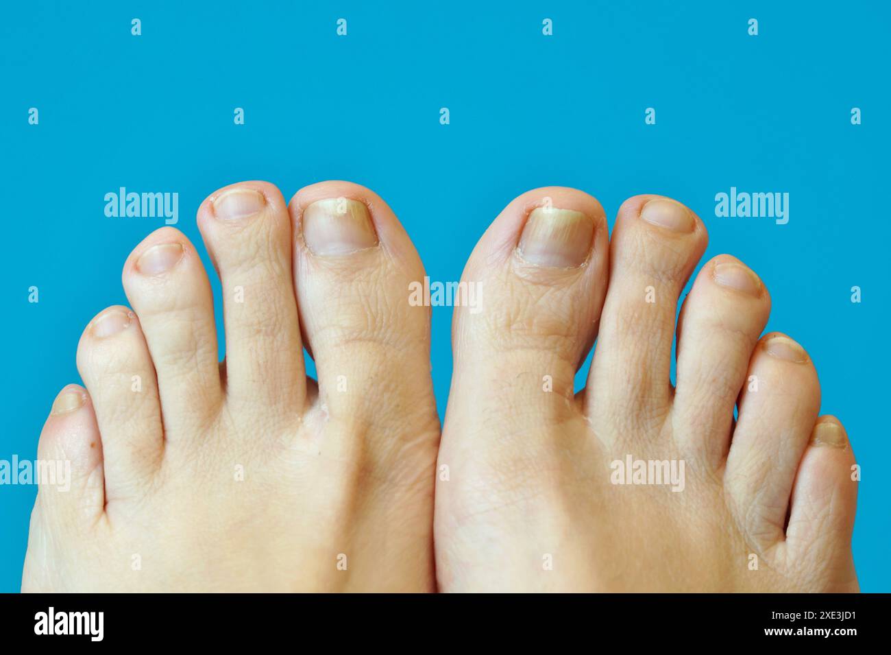 Femme pieds pieds jambes. orteils avec psoriasis unguéal. Une femme a des ongles incarnés. ongles coupés courts. Banque D'Images