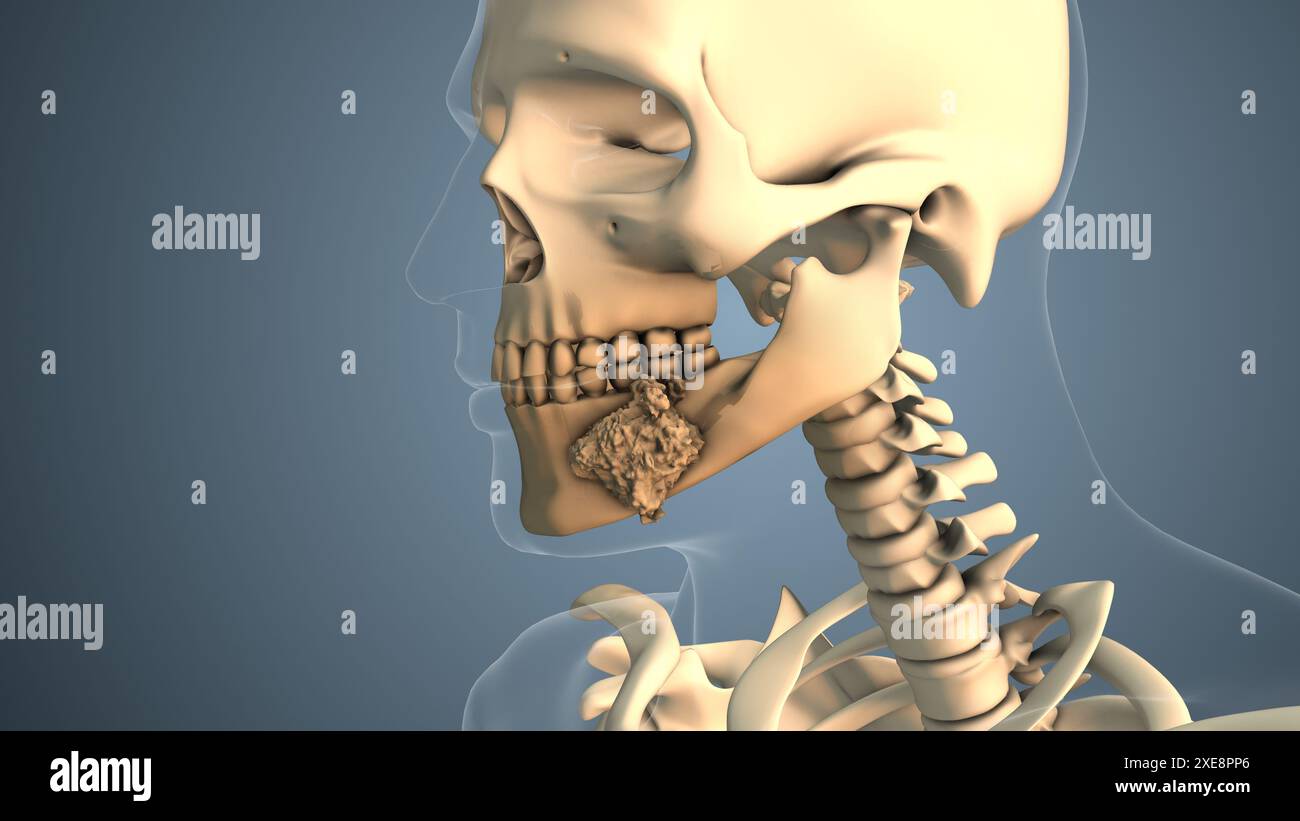 Cancer se propageant le long d'un os buccal Banque D'Images