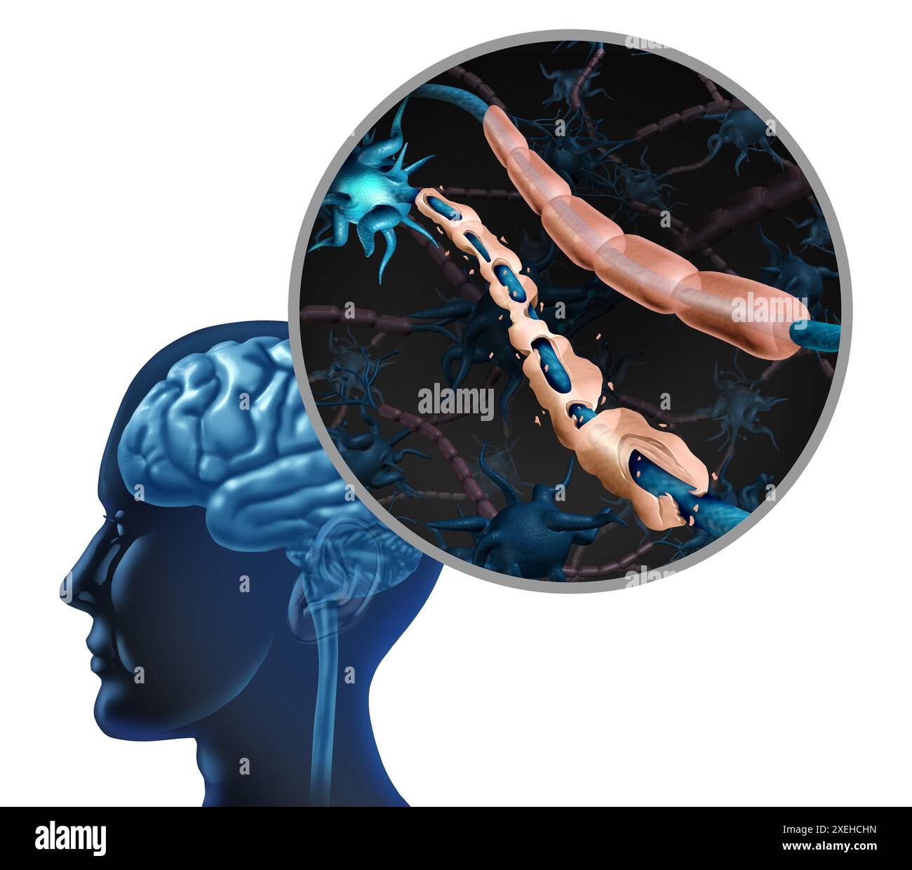 Maladie de sclérose en plaques trouble nerveux et myéline endommagée ou SEP auto-immune avec nerf sain avec fibre exposée et gaine cellulaire cicatrisée. Banque D'Images Maladie de sclérose en plaques trouble nerveux et myéline endommagée ou SEP auto-immune avec nerf sain avec fibre exposée et gaine cellulaire cicatrisée. Banque D'Images
