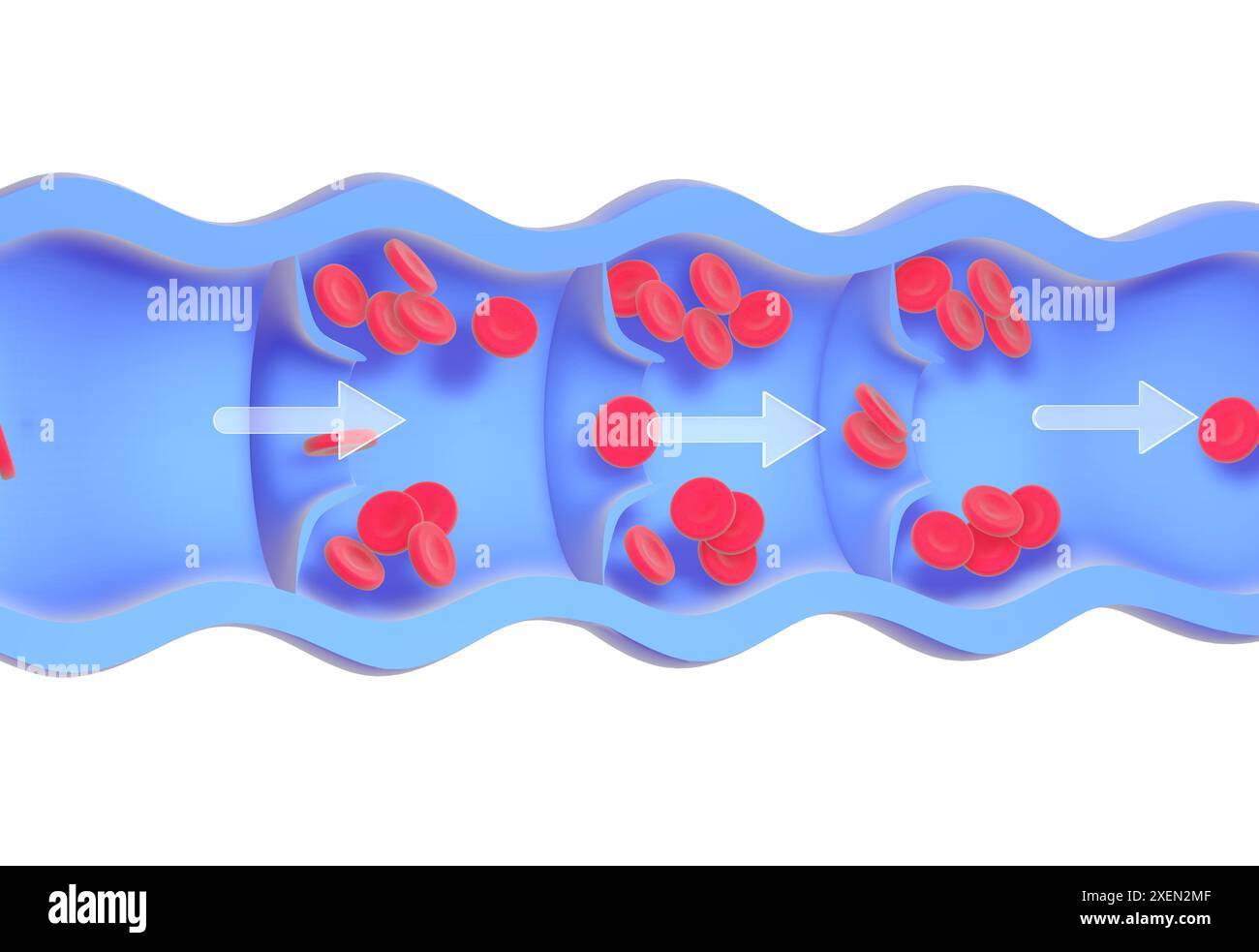 Animation anatomique 3e d'une veine malade et incompétente. Dysfonctionnement des valves, accumulation de globules rouges dans les parois, causant des varices. Banque D'Images