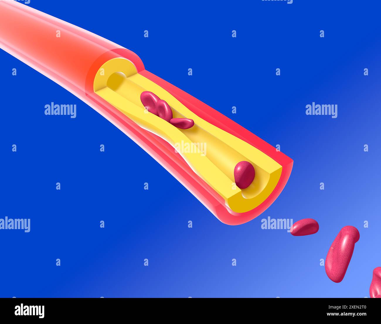 Illustration anatomique 3D d'une artère incompétente avec obstruction graisseuse. Mouvement des globules rouges et des plaquettes dans une mauvaise circulation sanguine. Banque D'Images
