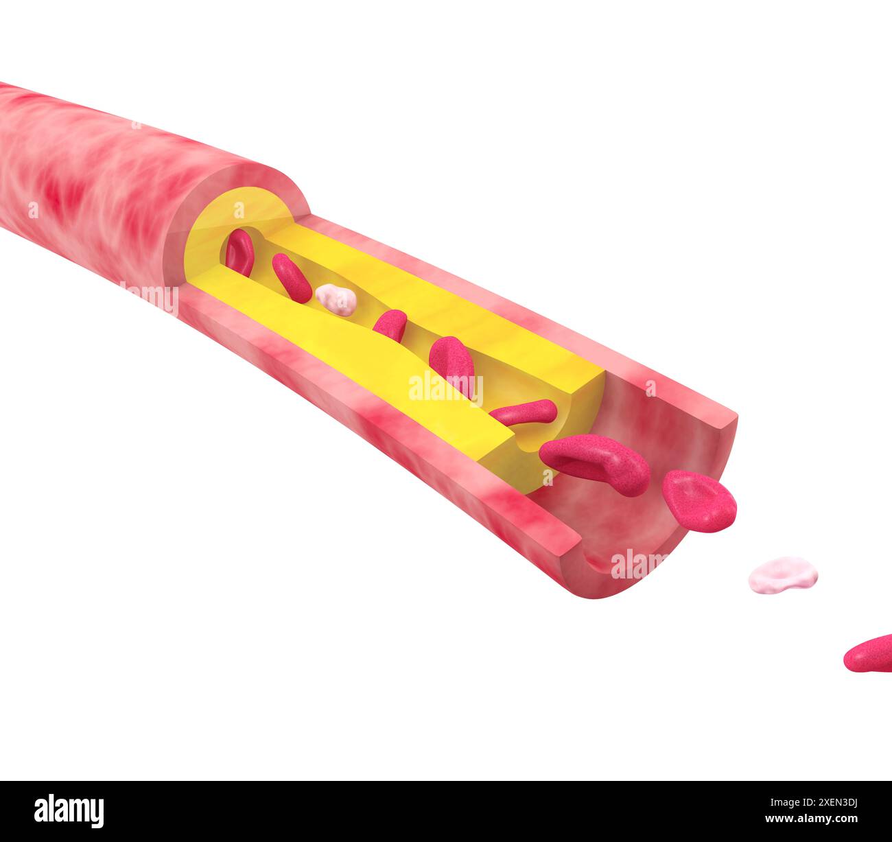 Illustration anatomique 3D de l'artère avec le mouvement de l'obstruction due à la graisse accumulée. Ralentit les globules rouges dans la circulation sanguine. Banque D'Images