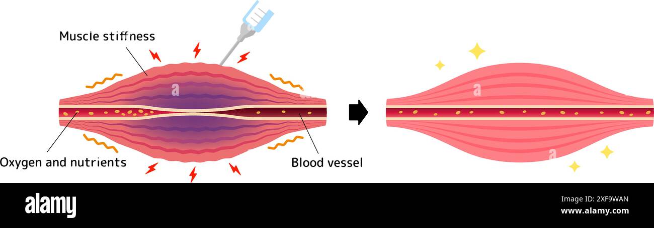 Mécanisme de relaxation musculaire par injection de toxine botulique Illustration de Vecteur