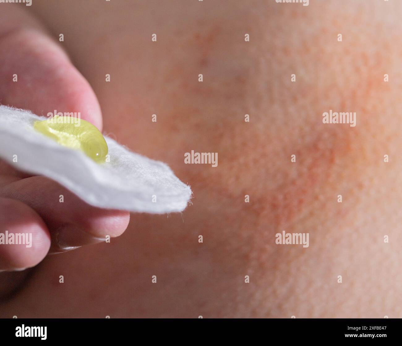 La main d un homme tient un coton avec un gel médical médicinal sur le fond d une bosse et d ecchymose après une injection. Traitement de la post-injection Banque D'Images