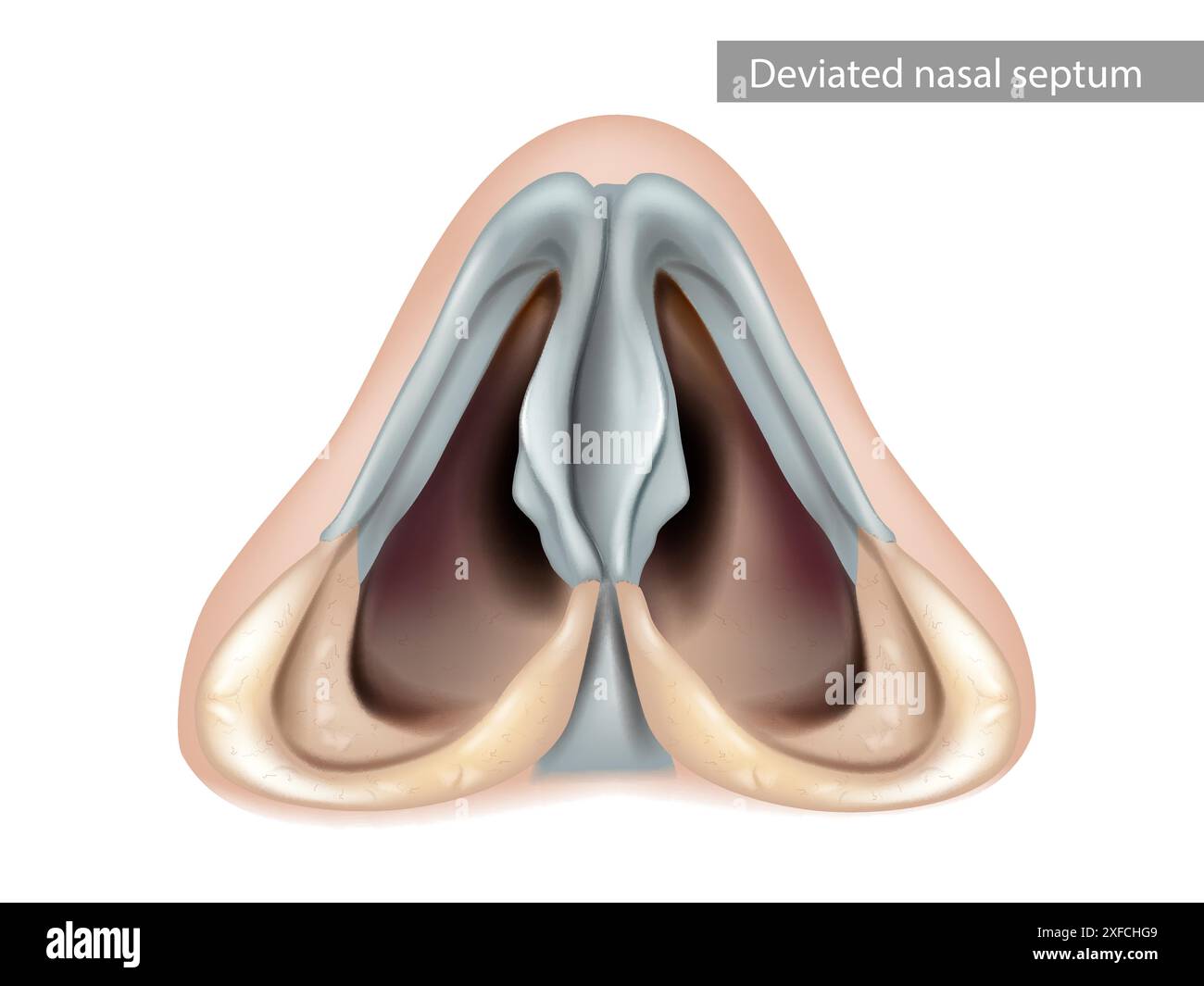 Septum nasal dévié. Nez, cavité nasale. Vue inférieure Illustration de Vecteur
