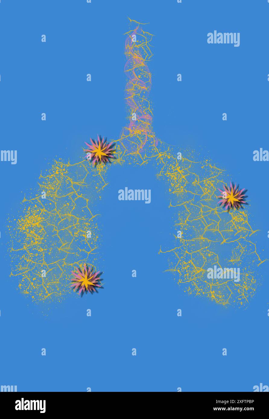 Concept des poumons infectés par la main du médecin, présence d'infection à mycobactéries tuberculeuses, tuberculose bactérienne, cancer du poumon et maladie pulmonaire Banque D'Images