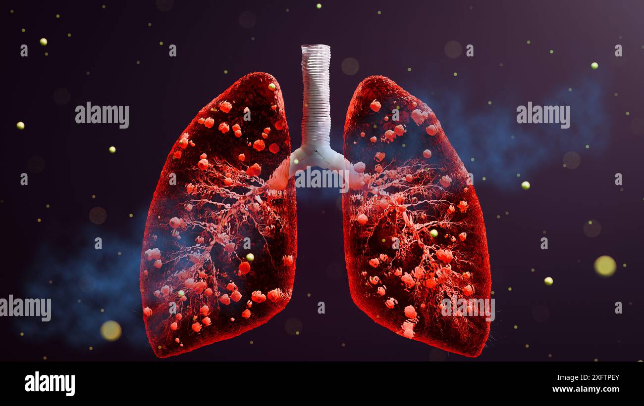 Concept des poumons infectés par la main du médecin, présence d'infection à mycobactéries tuberculeuses, tuberculose bactérienne, cancer du poumon et maladie pulmonaire Banque D'Images
