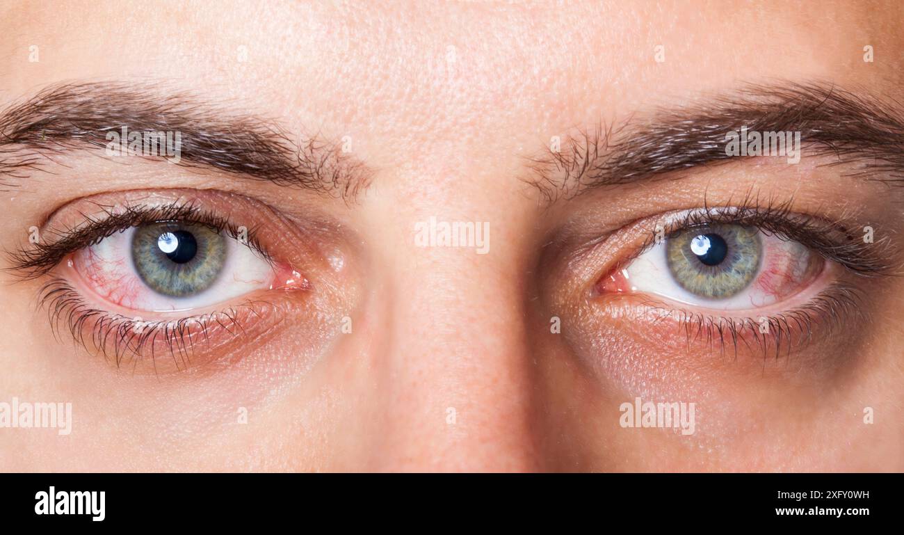 Close Up de deux yeux rouges du sang irritée. Banque D'Images