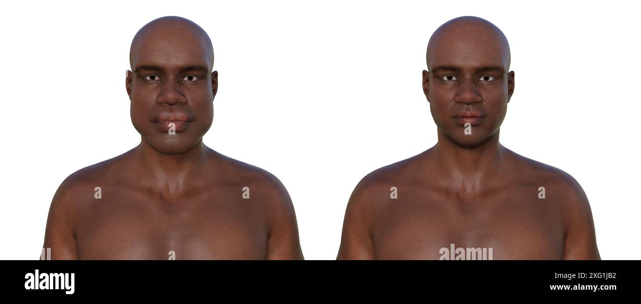 Illustration comparant un homme atteint d'acromégalie (à gauche) et le même homme en bonne santé (à droite). L'acromégalie est une condition provoquant une augmentation de la taille des mains et du visage due à la surproduction de somatotrophine (hormone de croissance humaine). Elle résulte généralement de la formation d'une tumeur bénigne (adénome) sur l'hypophyse. Banque D'Images