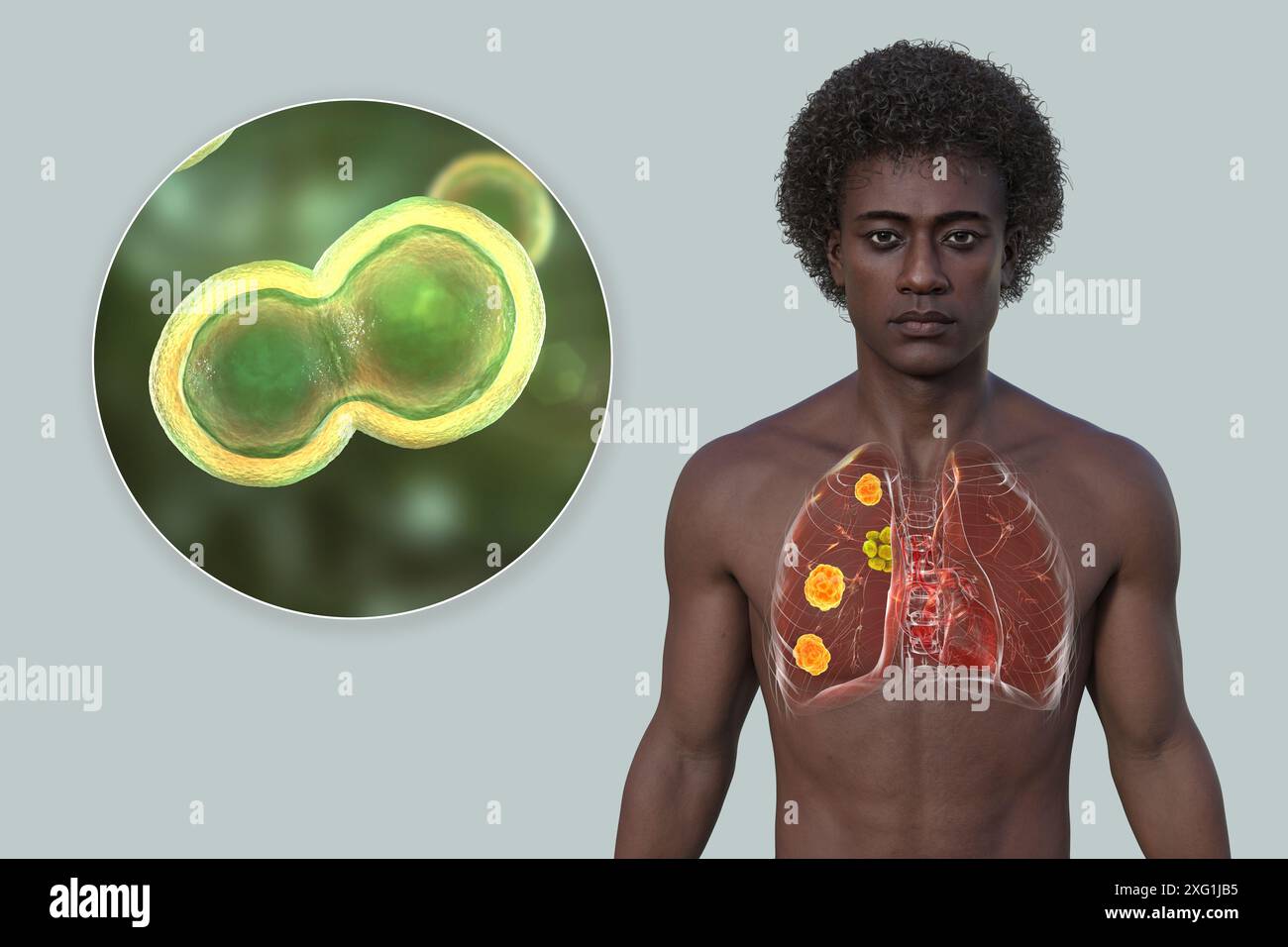 Illustration d'une blastomycose pulmonaire et gros plan sur le champignon responsable Blastomyces dermatitidis. La blastomycose est souvent asymptomatique, mais elle peut causer des lésions pulmonaires (orange) et une hypertrophie des ganglions lymphatiques bronchiques (jaune). Banque D'Images