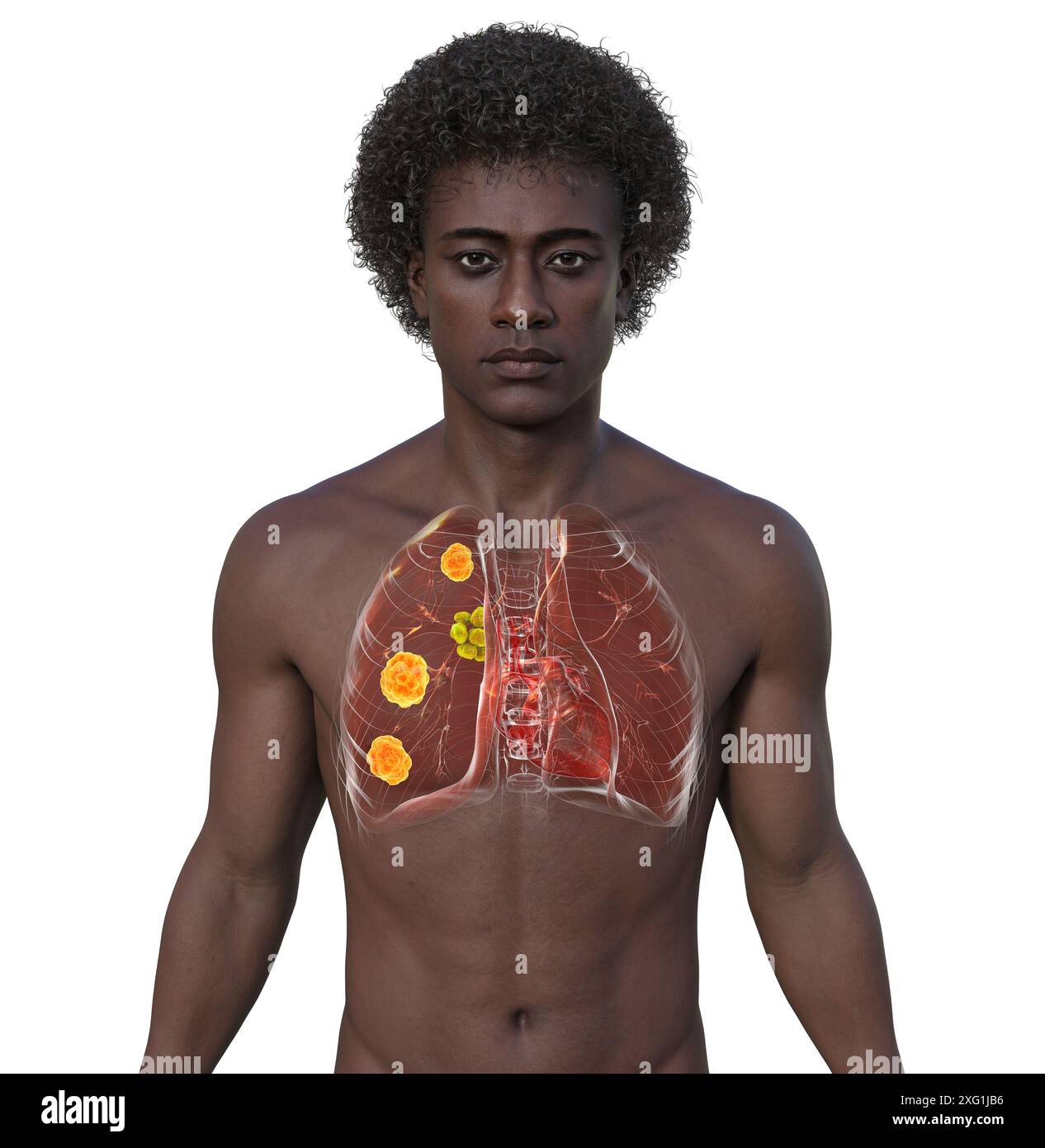 Illumination d'une blastomycose pulmonaire, infection pulmonaire fongique provoquée par l'inhalation de spores de Blastomyces dermatitidis. La blastomycose est souvent asymptomatique, mais elle peut causer des lésions pulmonaires (orange) et une hypertrophie des ganglions lymphatiques bronchiques (jaune). Banque D'Images