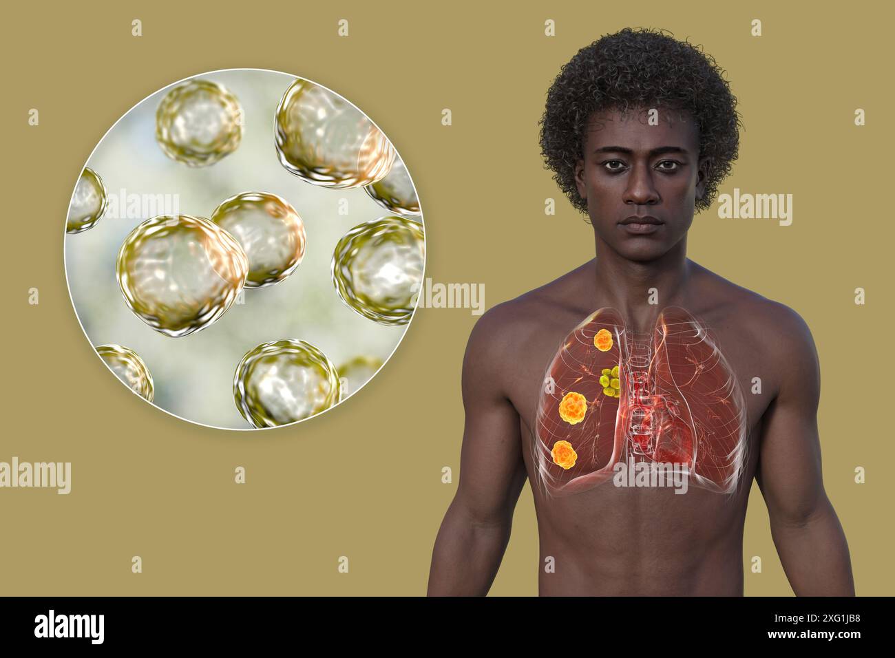 Illustration d'une blastomycose pulmonaire et gros plan sur le champignon responsable Blastomyces dermatitidis. La blastomycose est souvent asymptomatique, mais elle peut causer des lésions pulmonaires (orange) et une hypertrophie des ganglions lymphatiques bronchiques (jaune). Banque D'Images