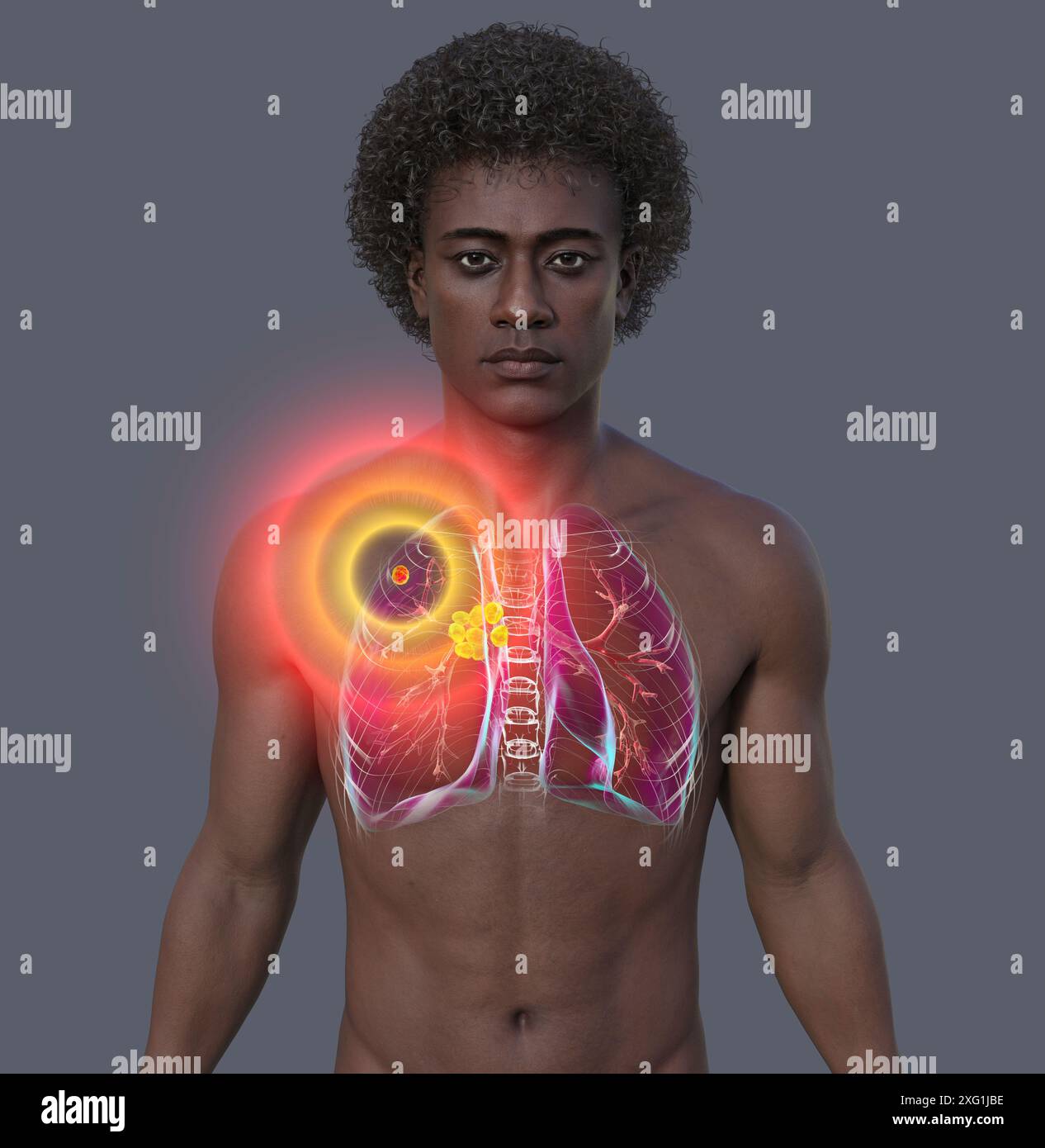 Illustration d'une cavité thoracique (thorax) d'un homme révélant un complexe de Ghon (jaune/orange) dans les poumons d'origine tuberculeuse. Un complexe de Ghon est une lésion dans les poumons constituée de ganglions lymphatiques gonflés qui contiennent des bactéries. La tuberculose est une infection bactérienne des poumons. Elle peut être grave si elle n'est pas traitée, mais les antibiotiques résolvent généralement l'infection. Banque D'Images