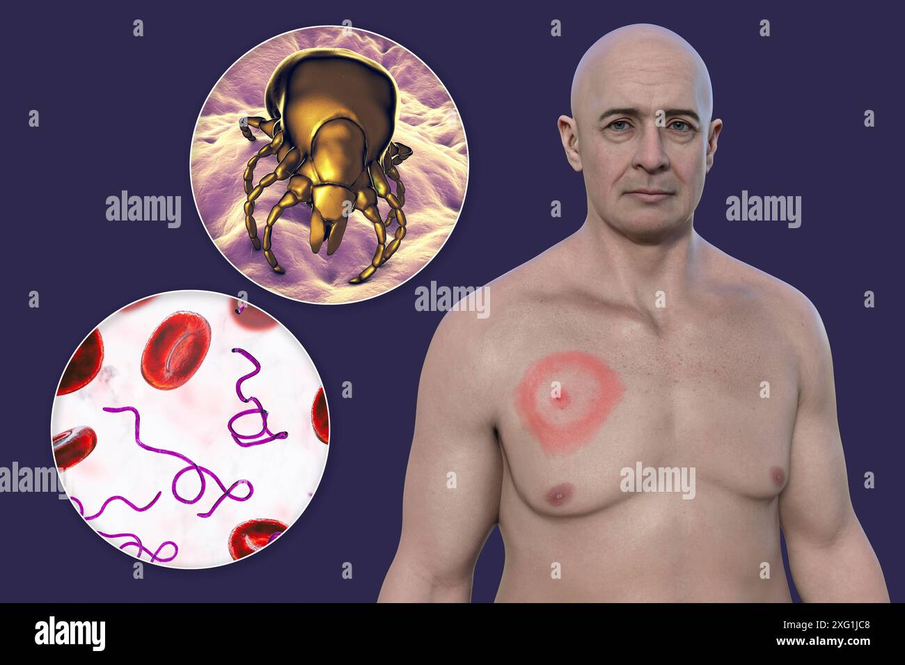 Illustration montrant un érythème migrant, une éruption cutanée caractéristique observée chez des patients atteints de la maladie de Lyme. La bactérie responsable Borrelia burgdorferi et le vecteur typique de tique sont tous deux montrés en gros plan. Banque D'Images