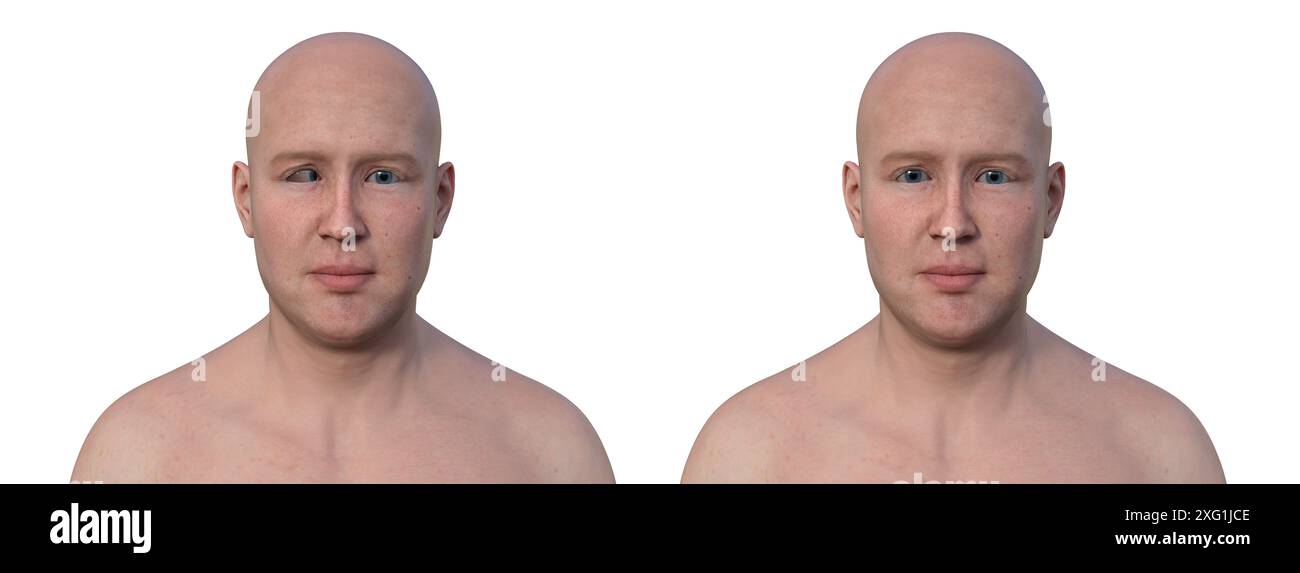 Illustration d'un homme atteint d'ésotropie montrant un mauvais alignement des yeux vers l'intérieur (à gauche) à côté du même homme en bonne santé (à droite). Banque D'Images
