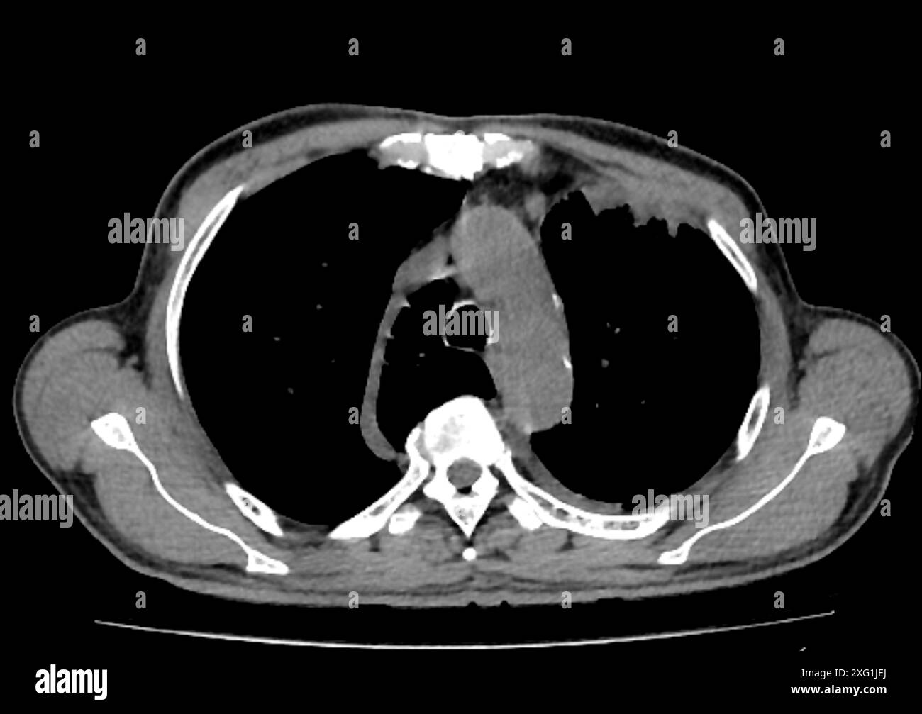 Tomodensitométrie (TDM) d'un thorax vu de dessus montrant un lobe azygos dans le poumon gauche (zone segmentée centre-gauche). Un lobe azygos est une variante anatomique du lobe supérieur du poumon dans laquelle un segment du poumon est séparé par une rainure profonde appelée fissure azygos, qui se compose de la veine azygos et de la plèvre (tissu mince). Il s'agit d'une variation rare, se produisant chez environ 0,3% des personnes au cours du développement embryonnaire. Il ne provoque aucun symptôme, mais peut rendre certaines interventions chirurgicales plus difficiles. Banque D'Images