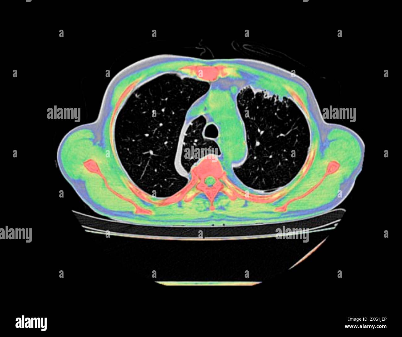 Tomodensitométrie (TDM) couleur d'un thorax vu du dessus montrant un lobe azygos dans le poumon gauche (zone segmentée centre-gauche). Un lobe azygos est une variante anatomique du lobe supérieur du poumon dans laquelle un segment du poumon est séparé par une rainure profonde appelée fissure azygos, qui se compose de la veine azygos et de la plèvre (tissu mince). Il s'agit d'une variation rare, se produisant chez environ 0,3% des personnes au cours du développement embryonnaire. Il ne provoque aucun symptôme, mais peut rendre certaines interventions chirurgicales plus difficiles. Banque D'Images
