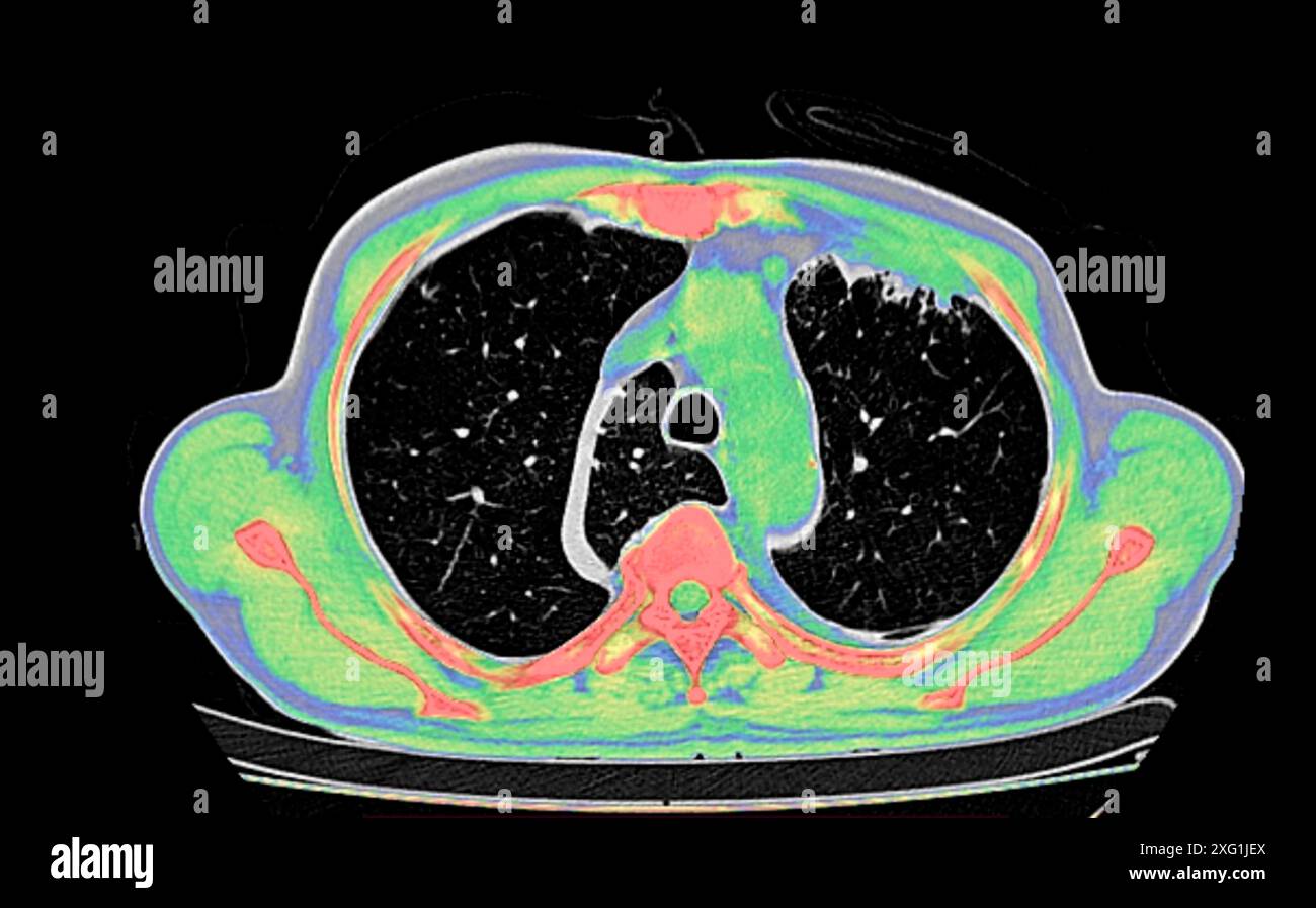 Tomodensitométrie (TDM) couleur d'un thorax vu du dessus montrant un lobe azygos dans le poumon gauche (zone segmentée centre-gauche). Un lobe azygos est une variante anatomique du lobe supérieur du poumon dans laquelle un segment du poumon est séparé par une rainure profonde appelée fissure azygos, qui se compose de la veine azygos et de la plèvre (tissu mince). Il s'agit d'une variation rare, se produisant chez environ 0,3% des personnes au cours du développement embryonnaire. Il ne provoque aucun symptôme, mais peut rendre certaines interventions chirurgicales plus difficiles. Banque D'Images