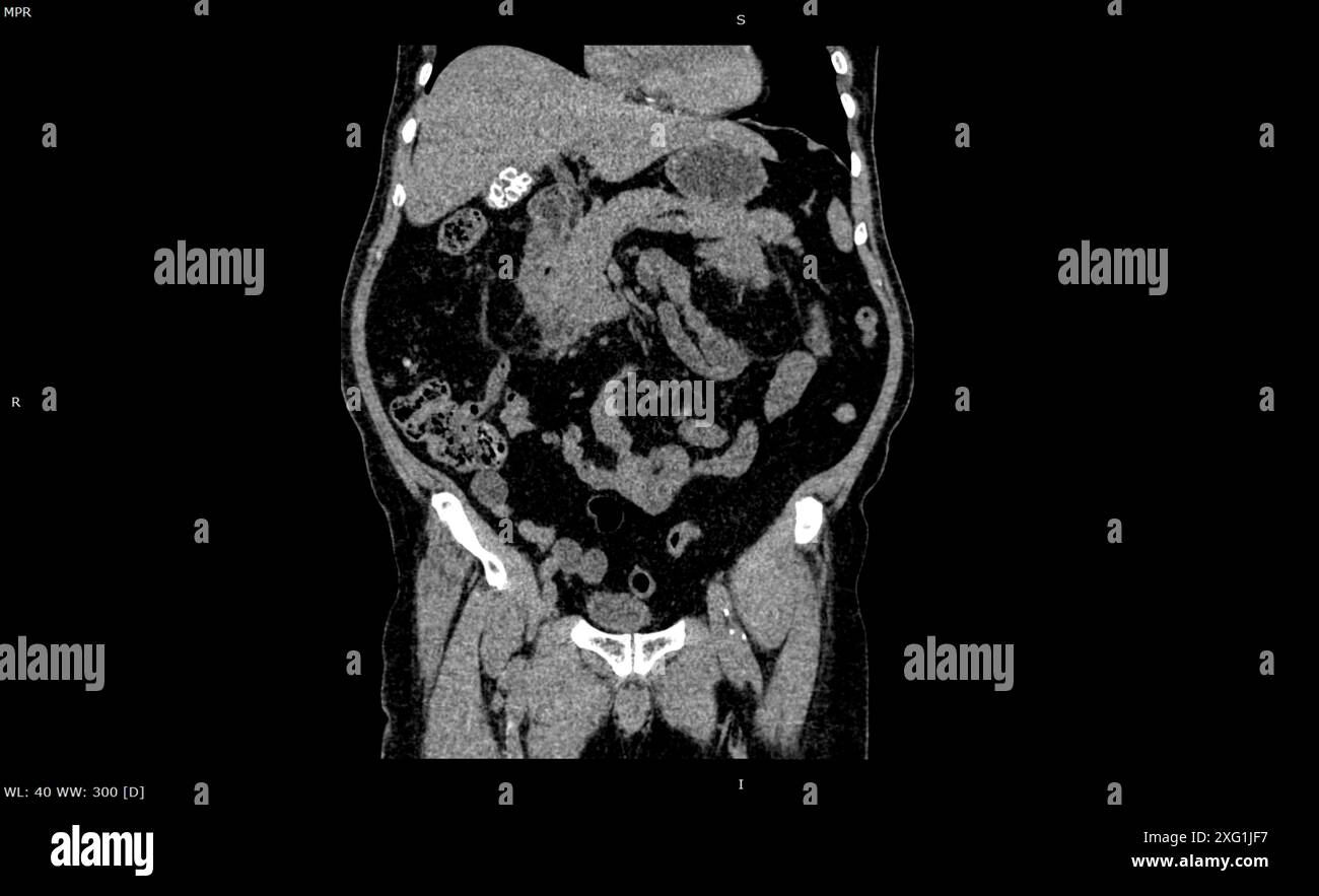 Scanner de l'avant de l'abdomen d'un patient atteint de lithiase biliaire ou de calculs biliaires (forme blanche en haut à gauche). Les calculs biliaires sont des grumeaux qui se forment sur la vésicule biliaire, généralement composés de cholestérol. Elles sont souvent sans symptômes, mais si elles obstruent les canaux dans l'estomac, elles peuvent causer une douleur intense. Si nécessaire, ils peuvent être enlevés par chirurgie en trou de serrure. Banque D'Images