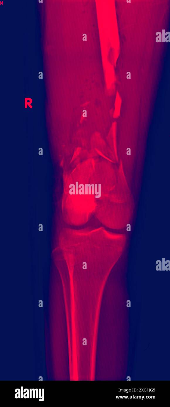 Radiographie colorée d'une fracture fragmentée du fémur (os de cuisse). Il s'agit d'un type de fracture dans laquelle un os s'est cassé en au moins deux endroits. Banque D'Images