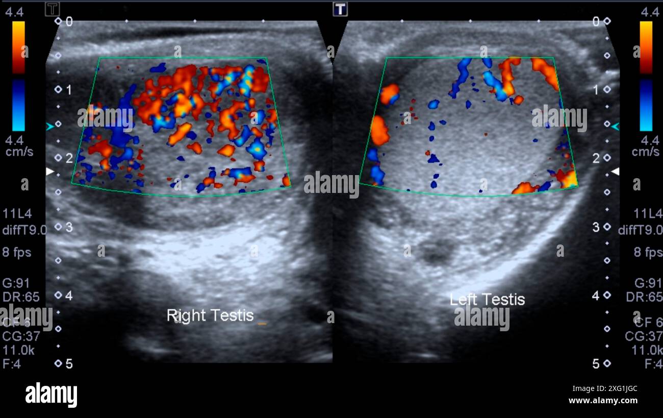 Échographie montrant une orchite, une infection des testicules. L’infection a provoqué une
