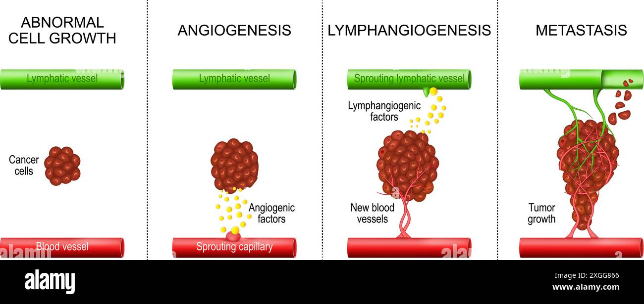 Cancer. Evolution tumorale de la croissance cellulaire anormale, de la lymphangiogenèse et de l'angiogenèse aux métastases. Propager les cellules cancéreuses d'un site initial à un d. Illustration de Vecteur