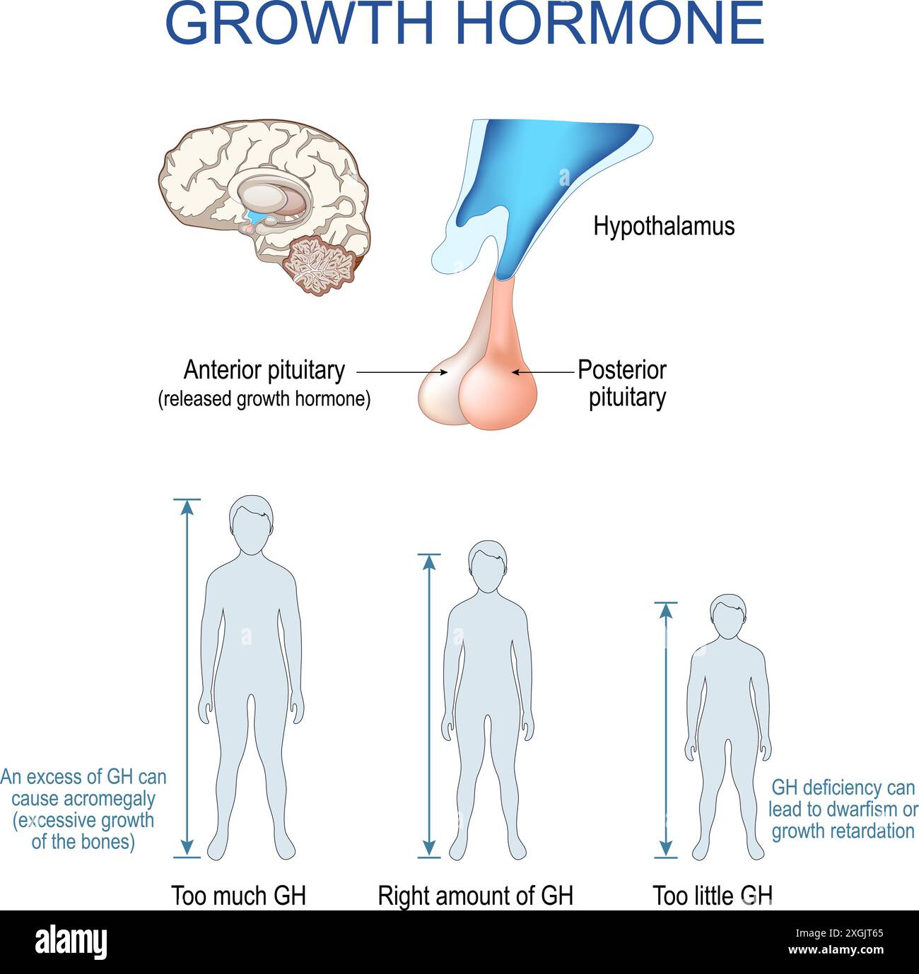 Hormone de croissance. Somatotropine. Gros plan d'un hypothalamus et d'une hypophyse. Hypophyse postérieure et antérieure. Un excès de GH provoque une acromégalie Illustration de Vecteur Hormone de croissance. Somatotropine. Gros plan d'un hypothalamus et d'une hypophyse. Hypophyse postérieure et antérieure. Un excès de GH provoque une acromégalie Illustration de Vecteur