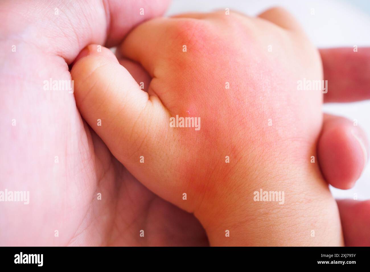 main de bébé avec éruption cutanée et allergie avec tache rouge causée par piqûre de moustique Banque D'Images