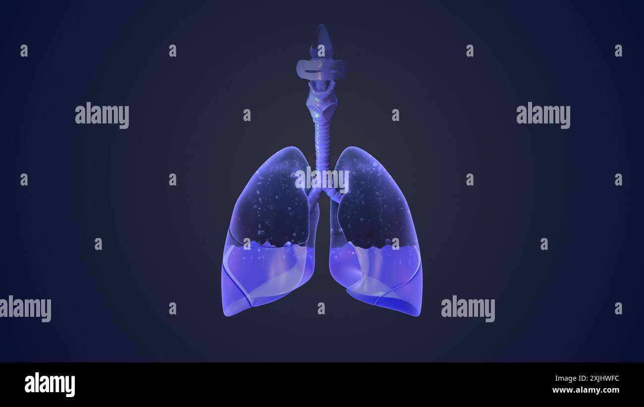 L'épanchement pleural représente une élimination inadéquate Banque D'Images