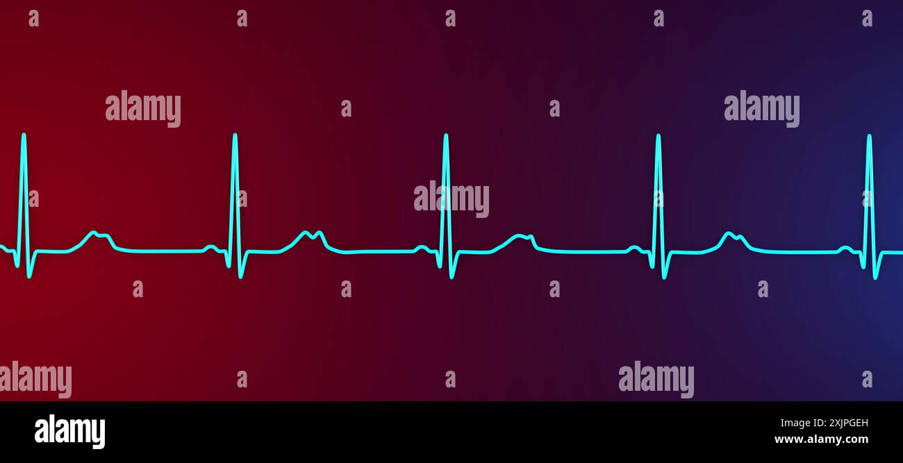 Illustration d'un électrocardiogramme (ECG) montrant un intervalle QT prolongé avec des ondes T entaillées et de plus faible amplitude, caractéristique du syndrome du QT long de type 2. Le syndrome du QT long est une affection cardiaque héréditaire qui affecte la façon dont le cœur bat et peut parfois provoquer des évanouissements ou des crises d’épilepsie. Banque D'Images