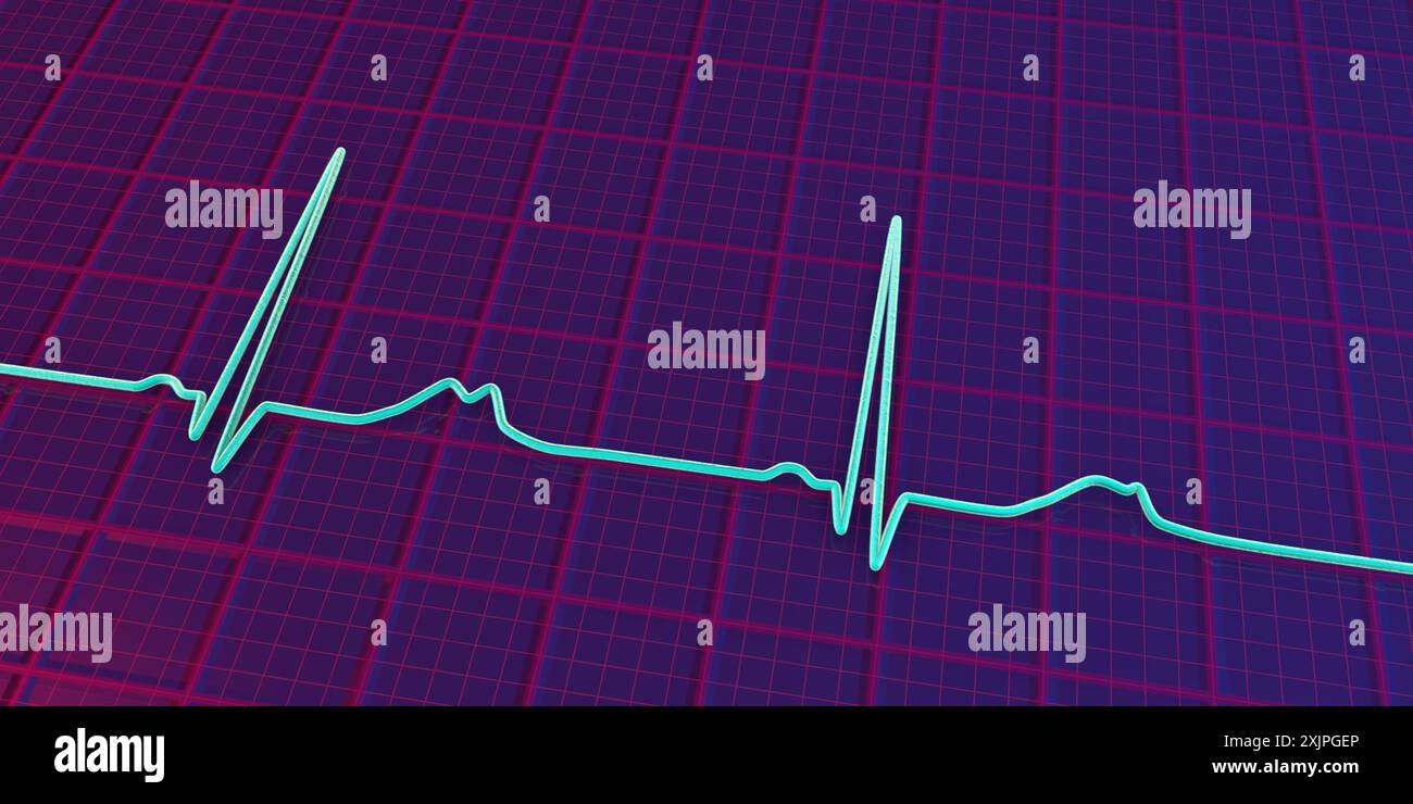 Illustration d'un électrocardiogramme (ECG) montrant un intervalle QT prolongé avec des ondes T entaillées et de plus faible amplitude, caractéristique du syndrome du QT long de type 2. Le syndrome du QT long est une affection cardiaque héréditaire qui affecte la façon dont le cœur bat et peut parfois provoquer des évanouissements ou des crises d’épilepsie. Banque D'Images