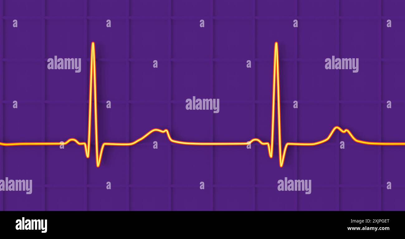 Illustration d'un électrocardiogramme (ECG) montrant un intervalle QT prolongé avec des ondes T entaillées et de plus faible amplitude, caractéristique du syndrome du QT long de type 2. Le syndrome du QT long est une affection cardiaque héréditaire qui affecte la façon dont le cœur bat et peut parfois provoquer des évanouissements ou des crises d’épilepsie. Banque D'Images